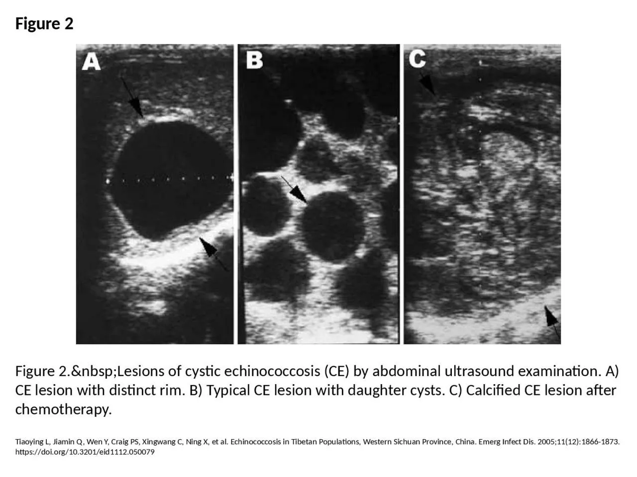 Figure 2 Figure 2.&nbsp;Lesions of cystic echinococcosis (CE) by abdominal ultrasound