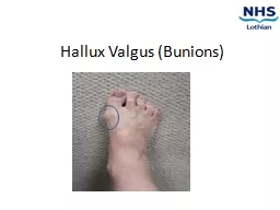 Hallux   Valgus  (Bunions)