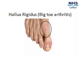 Hallux   Rigidus  (Big toe arthritis)