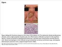 Figure Figure.&nbsp;A) Crustosus plaque on the nose of the patient. B) The epidermis shows para