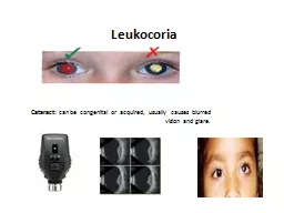 Leukocoria   Cataract:  can be congenital or acquired, usually causes blurred vision and