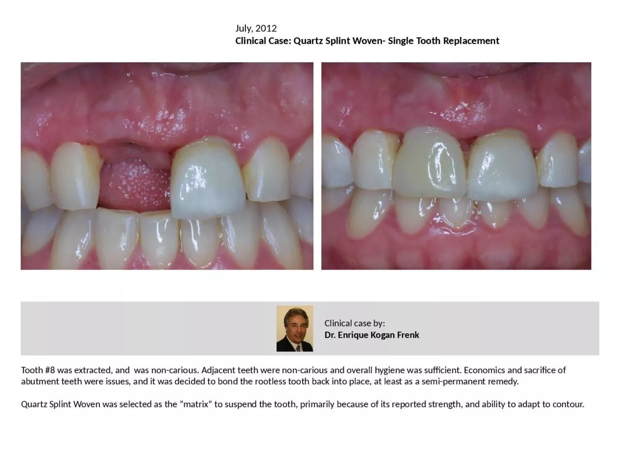 PPT-Tooth #8 was extracted, and was non-carious. Adjacent teeth were non-carious and overall