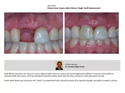 Tooth #8 was extracted, and  was non-carious. Adjacent teeth were non-carious and overall hygiene w