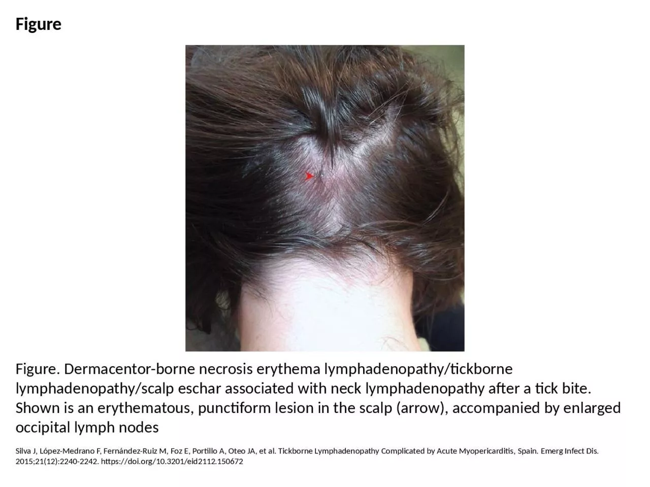 PPT-Figure Figure. Dermacentor-borne necrosis erythema lymphadenopathy/tickborne lymphadenopathy/scalp