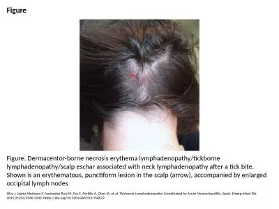 Figure Figure. Dermacentor-borne necrosis erythema lymphadenopathy/tickborne lymphadenopathy/scalp