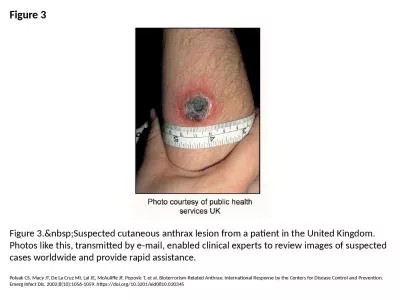 Figure 3 Figure 3.&nbsp;Suspected cutaneous anthrax lesion from a patient in the United