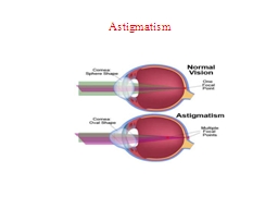 Astigmatism Recognizing the presence of astigmatism