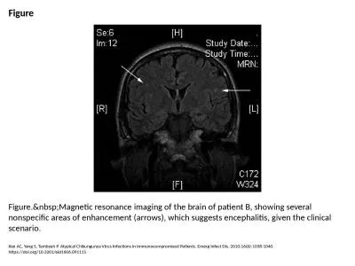 Figure Figure.&nbsp;Magnetic resonance imaging of the brain of patient B, showing