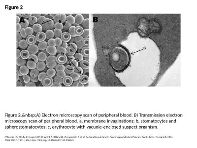 Figure 2 Figure 2.&nbsp;A) Electron microscopy scan of peripheral blood. B) Transmission