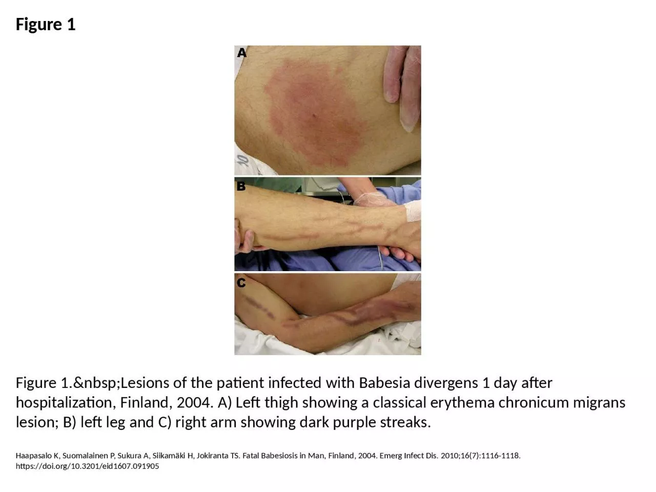 PPT-Figure 1 Figure 1.&nbsp;Lesions of the patient infected with Babesia divergens 1 day