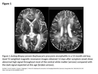 Figure 1 Figure 1.&nbsp;Biopsy-proven Baylisascaris procyonis encephalitis in a 13-month-old bo