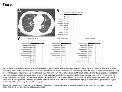 Figure Figure. Chest computed tomography scan and sequencing of the 16S amplicon in a