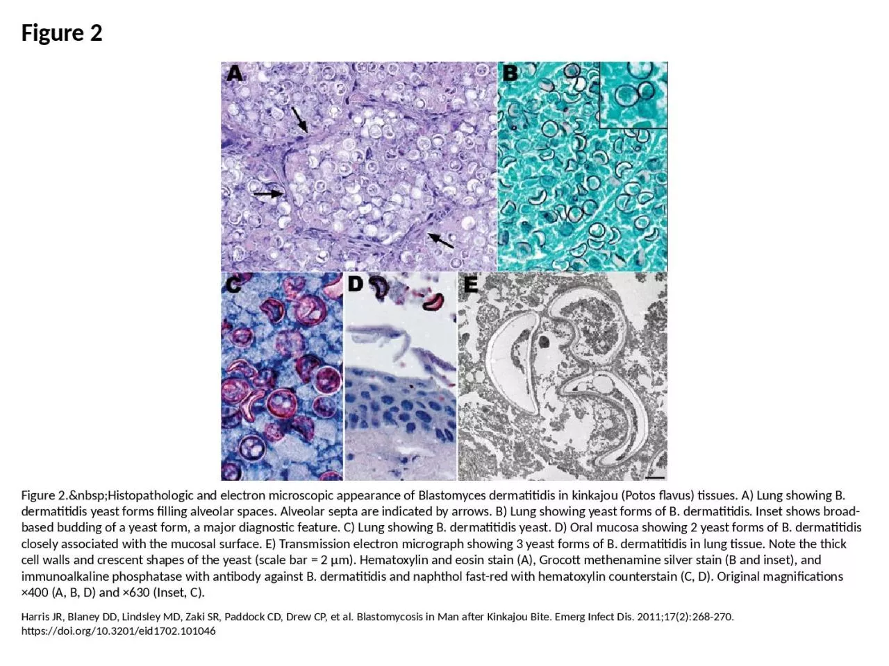 PPT-Figure 2 Figure 2.&nbsp;Histopathologic and electron microscopic appearance of Blastomyces