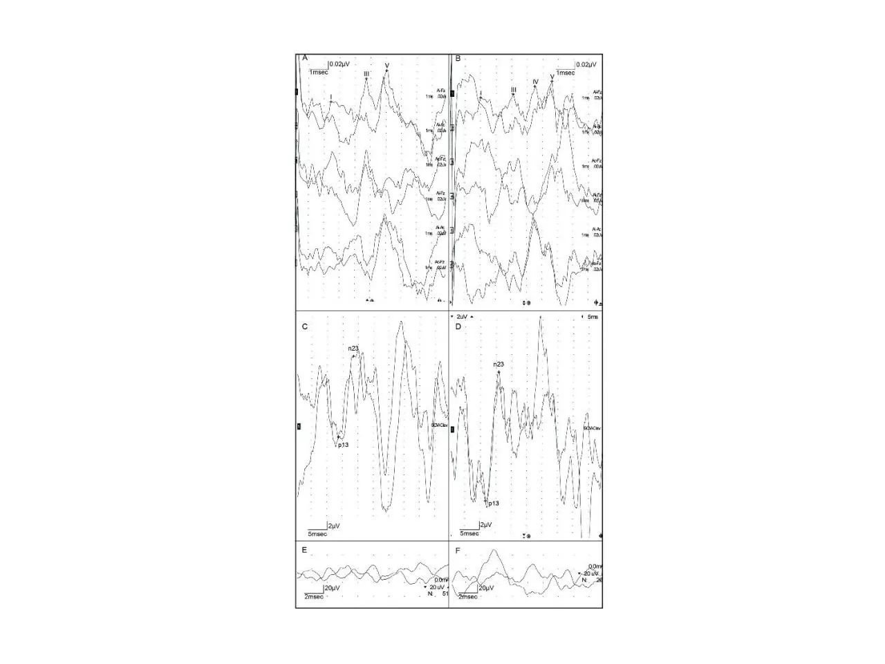 PPT-Supplemental Digital Content 4. Brainstem auditory evoked potentials with left ear