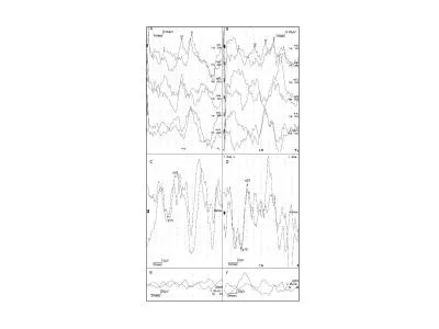 Supplemental Digital Content 4. Brainstem auditory evoked potentials with left ear