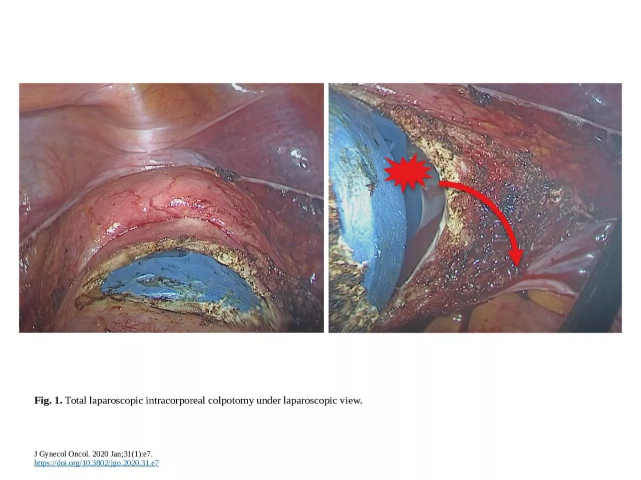 PPT-Fig. 1.  Total laparoscopic intracorporeal colpotomy under laparoscopic view.