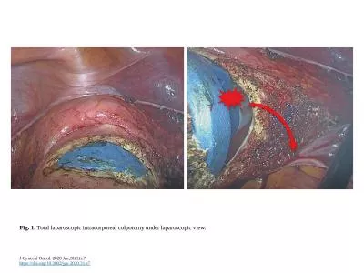 Fig. 1.  Total laparoscopic intracorporeal colpotomy under laparoscopic view.