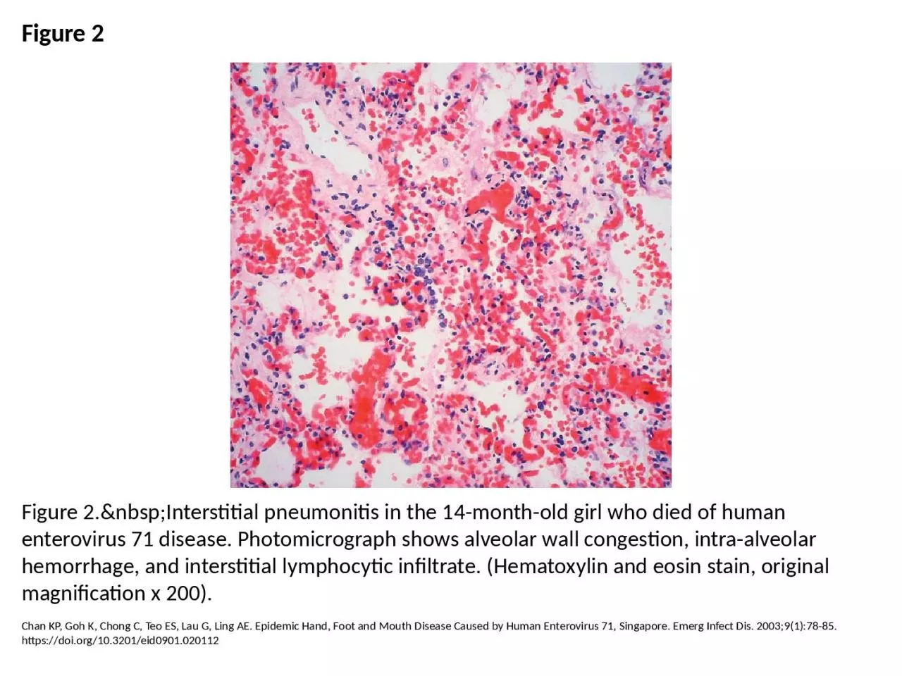 PPT-Figure 2 Figure 2.&nbsp;Interstitial pneumonitis in the 14-month-old girl who died