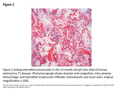 Figure 2 Figure 2.&nbsp;Interstitial pneumonitis in the 14-month-old girl who died of human ent