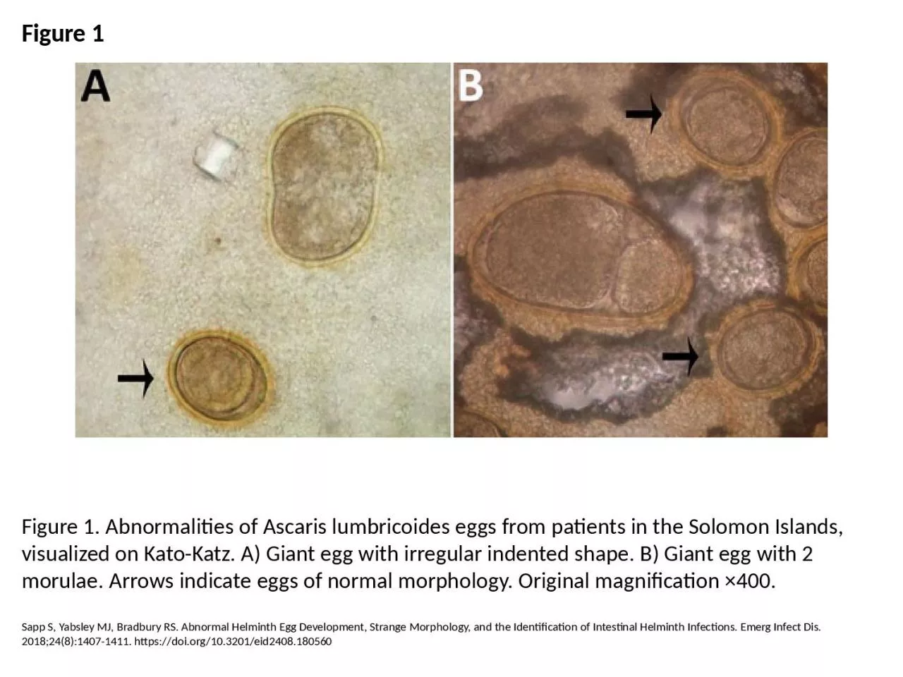 PPT-Figure 1 Figure 1. Abnormalities of Ascaris lumbricoides eggs from patients in the Solomon