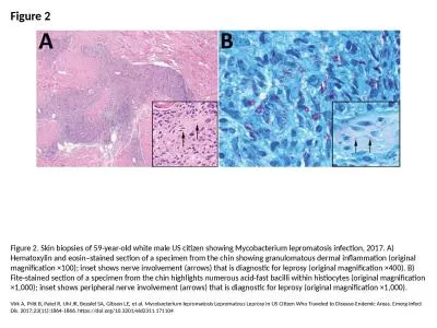 Figure 2 Figure 2. Skin biopsies of 59-year-old white male US citizen showing Mycobacterium leproma