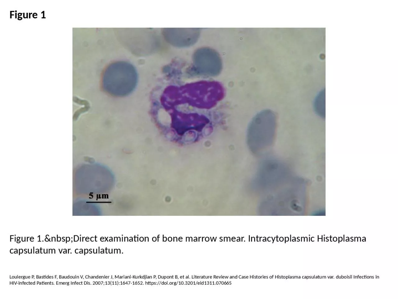 PPT-Figure 1 Figure 1.&nbsp;Direct examination of bone marrow smear. Intracytoplasmic