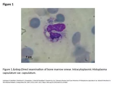 Figure 1 Figure 1.&nbsp;Direct examination of bone marrow smear. Intracytoplasmic Histoplasma c