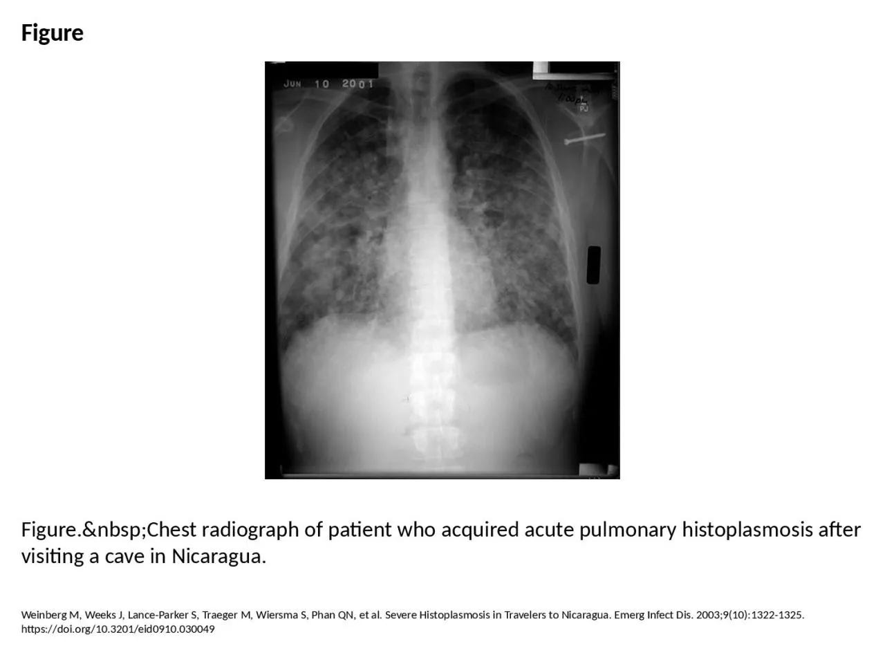 PPT-Figure Figure.&nbsp;Chest radiograph of patient who acquired acute pulmonary histoplasmosis