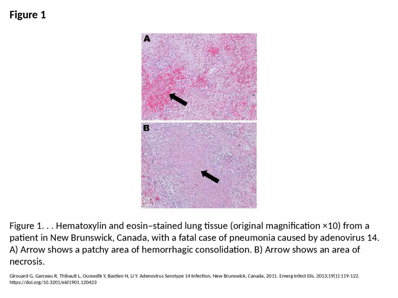 PPT-Figure 1 Figure 1. . . Hematoxylin and eosin–stained lung tissue (original magnification