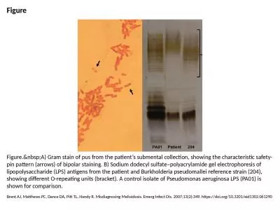 Figure Figure.&nbsp;A) Gram stain of pus from the patient’s submental collection, showing the