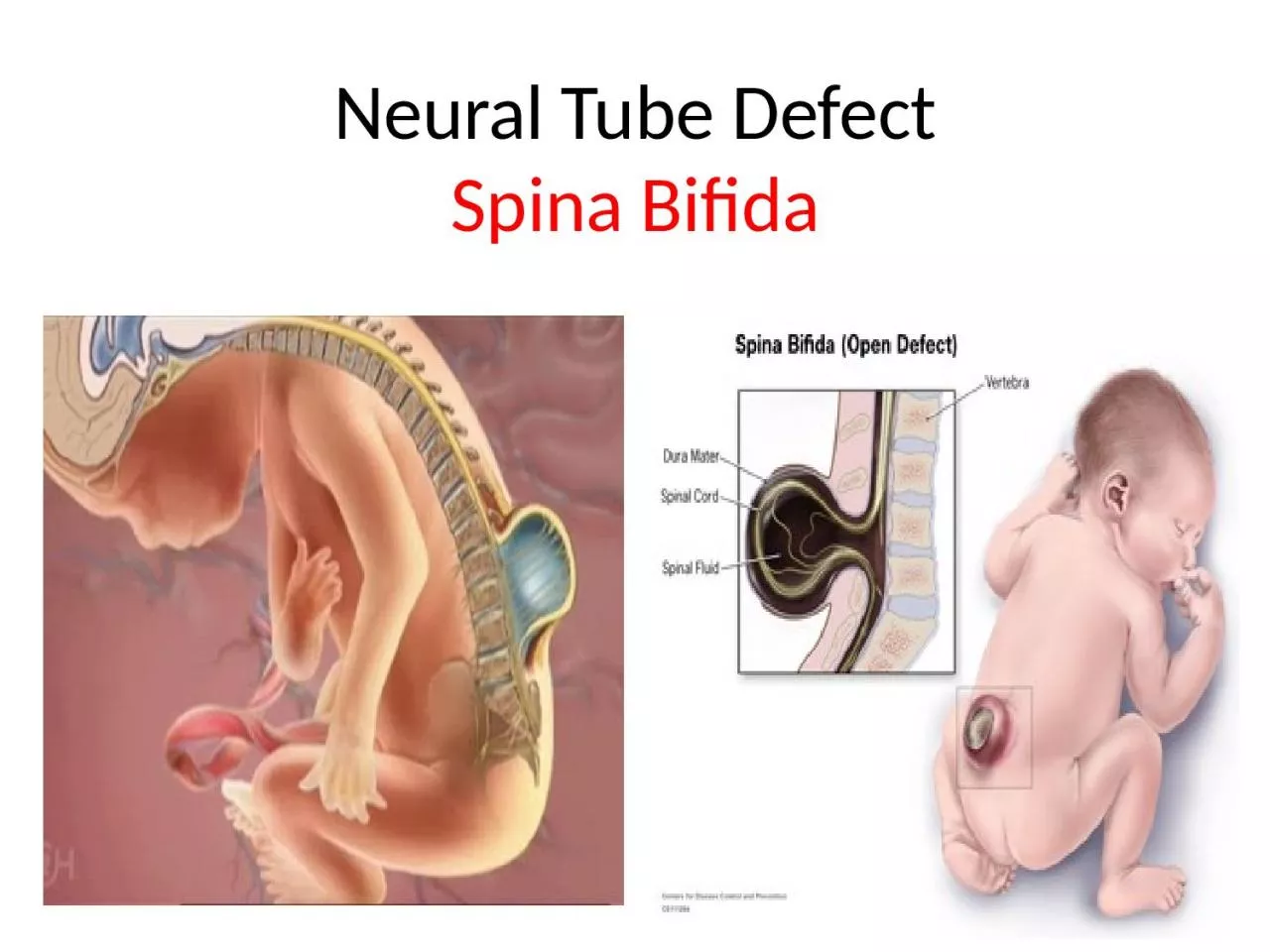 PPT-Neural Tube Defect Spina