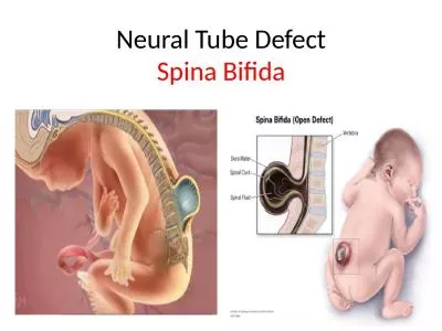 Neural Tube Defect Spina