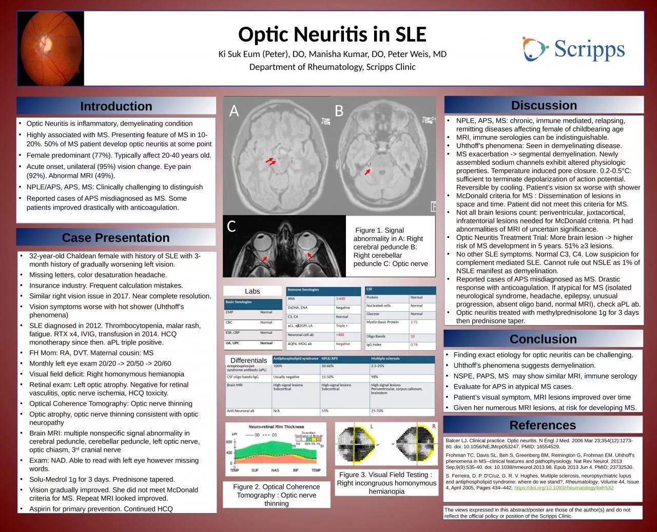 PPT-Optic Neuritis in SLE Ki Suk Eum (Peter), DO, Manisha Kumar, DO, Peter Weis, MD