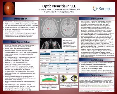 Optic Neuritis in SLE Ki Suk Eum (Peter), DO, Manisha Kumar, DO, Peter Weis, MD