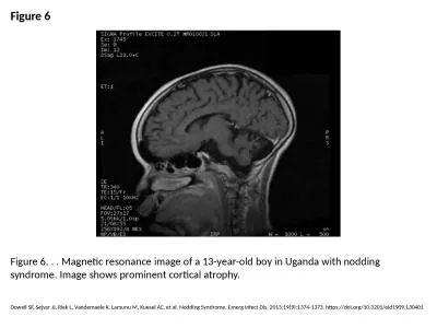 Figure 6 Figure 6. . . Magnetic resonance image of a 13-year-old boy in Uganda with nodding