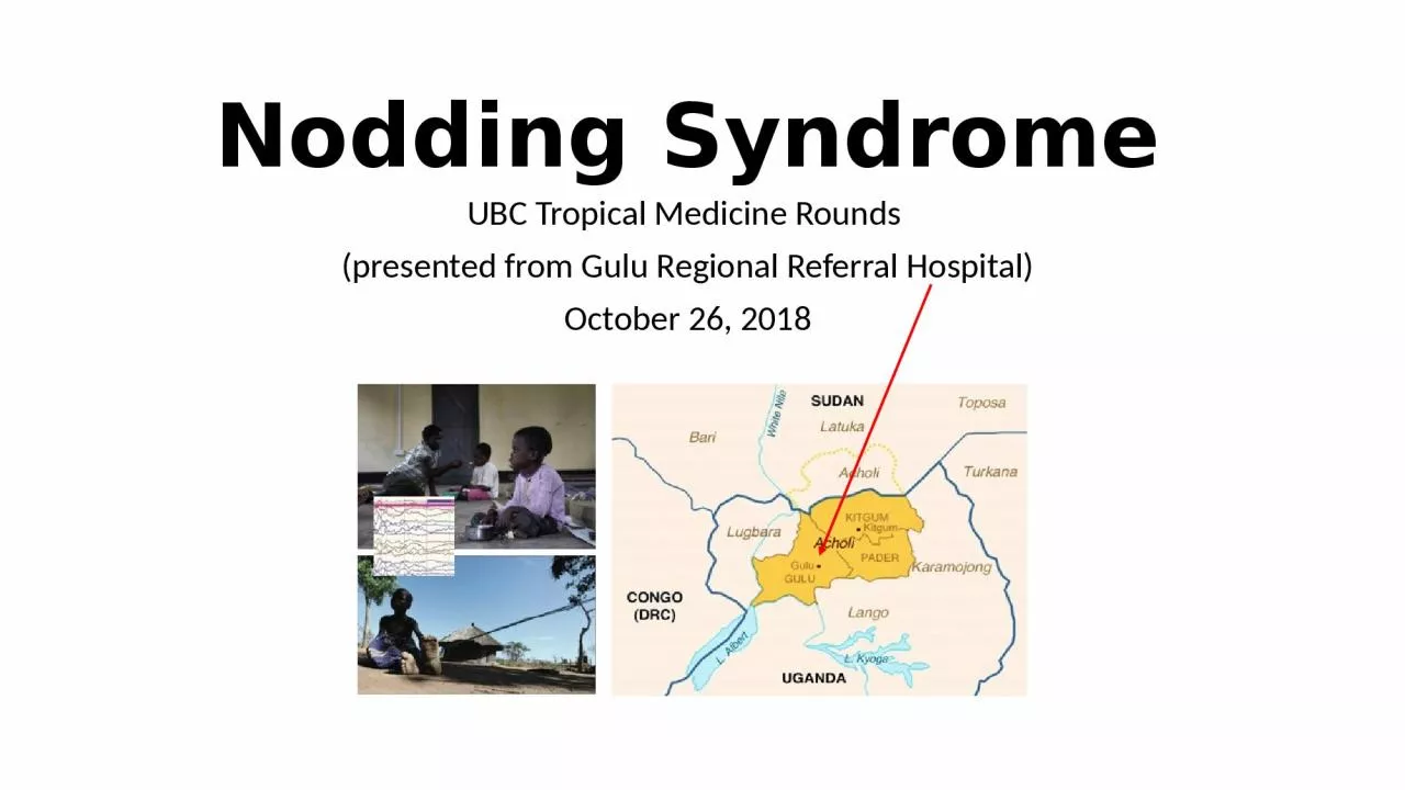 PPT-Nodding Syndrome UBC Tropical Medicine Rounds