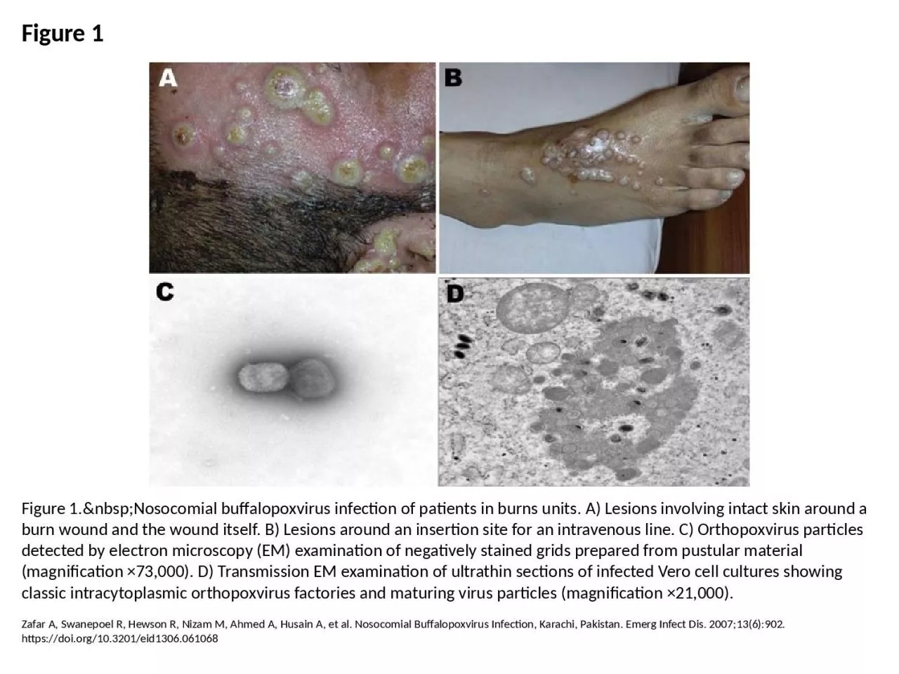 PPT-Figure 1 Figure 1.&nbsp;Nosocomial buffalopoxvirus infection of patients in burns