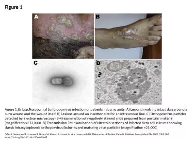 Figure 1 Figure 1.&nbsp;Nosocomial buffalopoxvirus infection of patients in burns units. A) Les