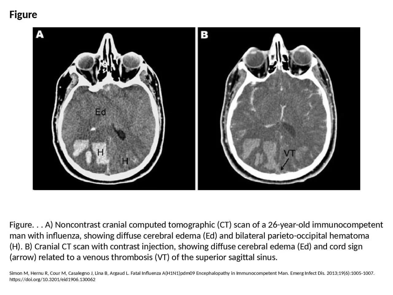Figure Figure. . . A) Noncontrast cranial computed tomographic (CT) scan of a 26-year-old