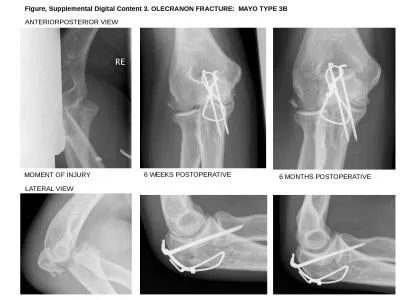 Figure, Supplemental Digital Content 3. OLECRANON