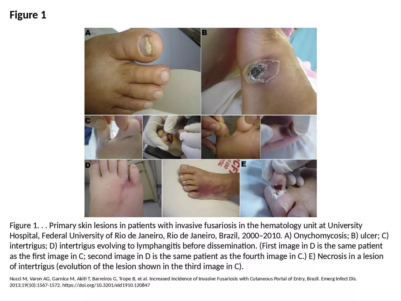 PPT-Figure 1 Figure 1. . . Primary skin lesions in patients with invasive fusariosis in the