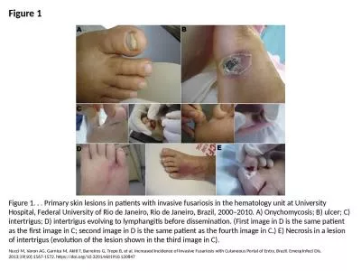 Figure 1 Figure 1. . . Primary skin lesions in patients with invasive fusariosis in the