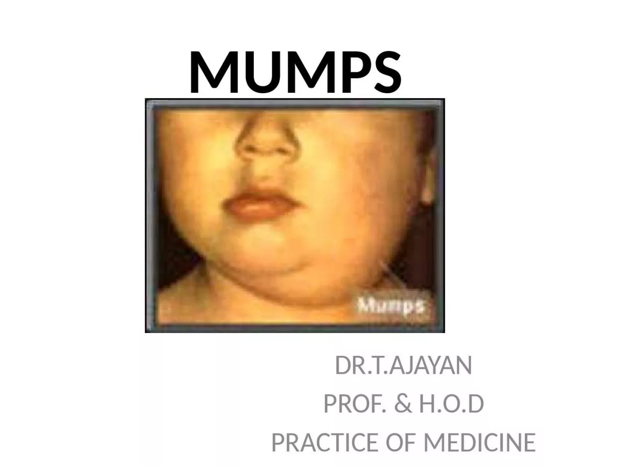 PPT-MUMPS DR.T.AJAYAN PROF. & H.O.D