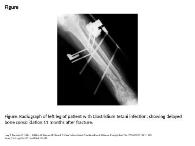 Figure Figure. Radiograph of left leg of patient with Clostridium tetani infection, showing