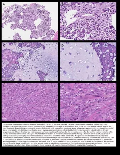 Conventional intramedullary osteosarcoma may present with a variety of histologic subtypes. The mos