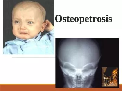 Osteopetrosis Definition