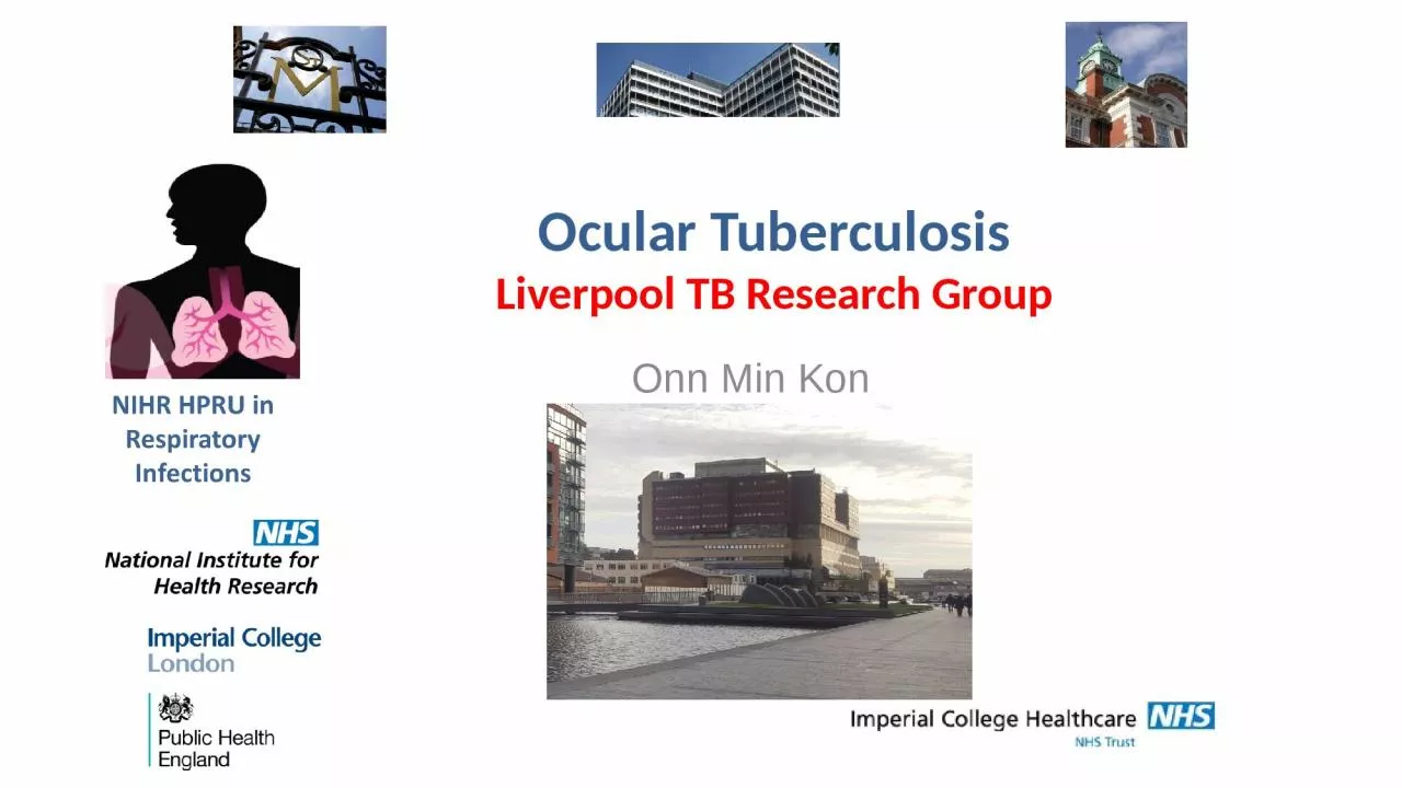 PPT-Onn Min Kon Ocular Tuberculosis