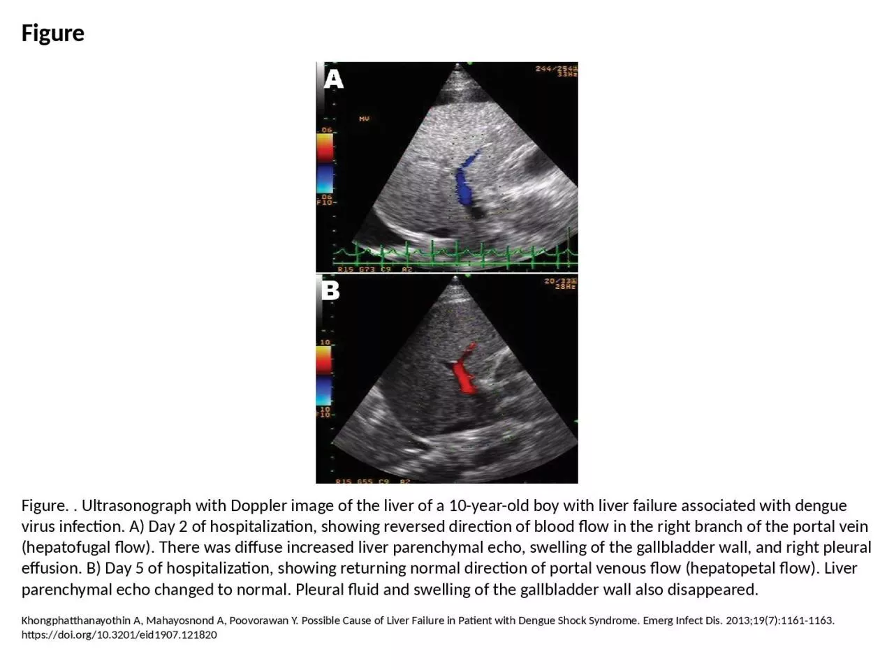 Figure Figure. . Ultrasonograph with Doppler image of the liver of a 10-year-old boy with