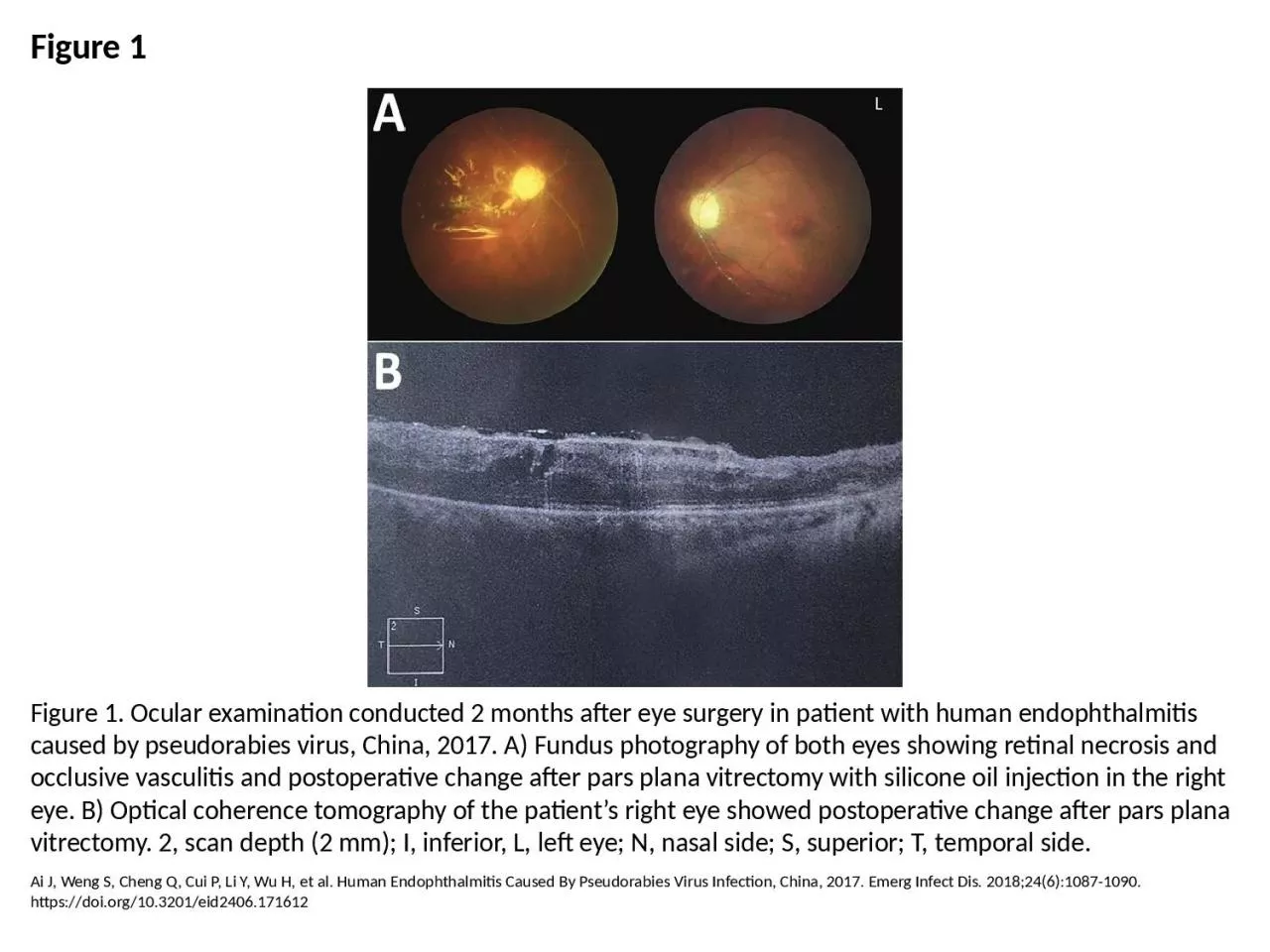 PPT-Figure 1 Figure 1. Ocular examination conducted 2 months after eye surgery in patient