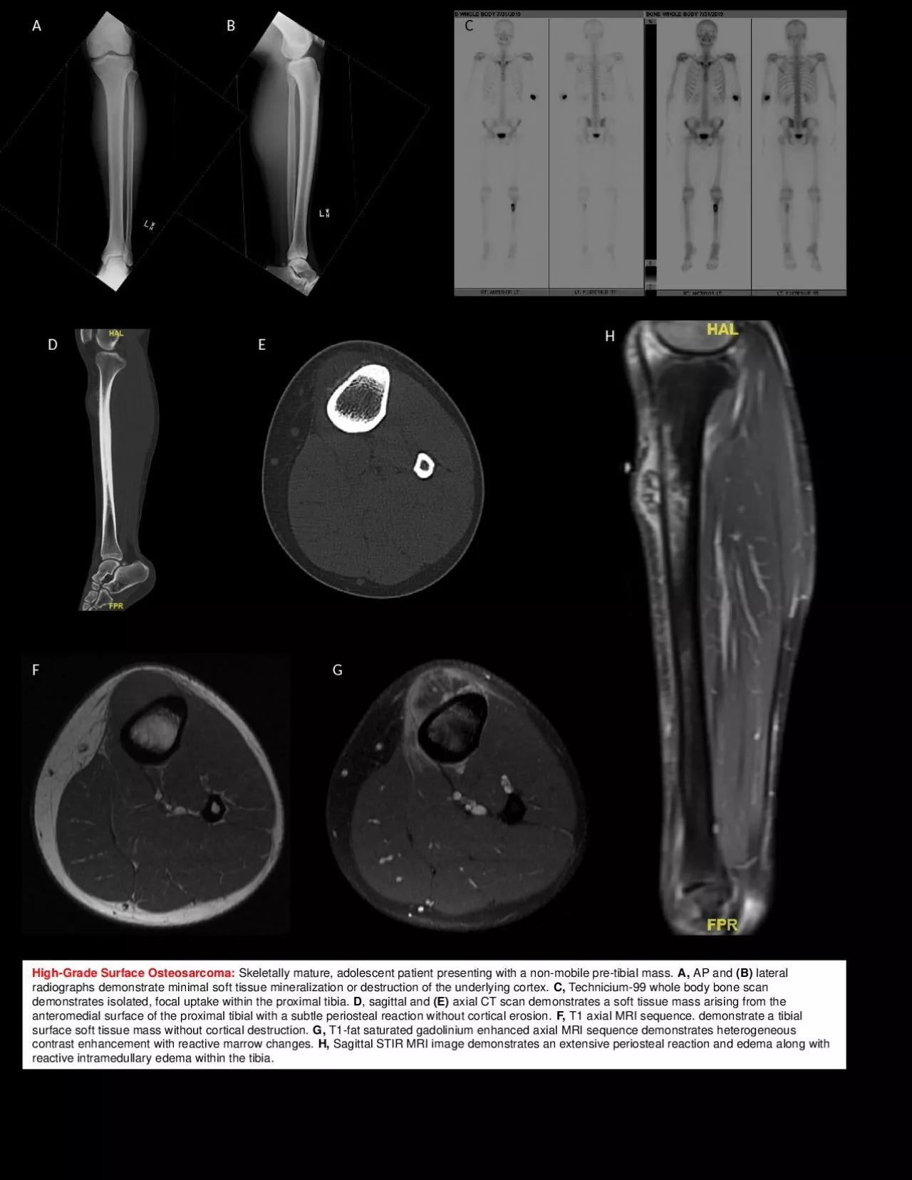 PPT-High-Grade Surface Osteosarcoma: